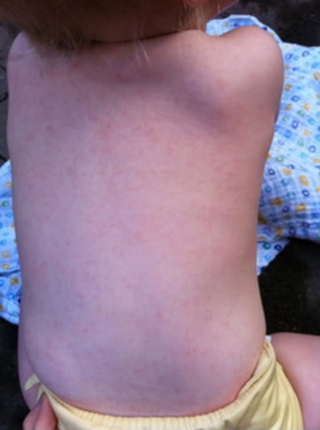 WDYT This rash is? - 12-24 Months - Essential Baby